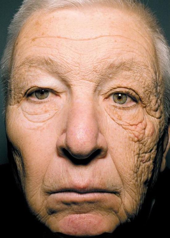 ▲根據(jù)《新英格蘭醫(yī)學雜志》報道，69歲的Bill McElligott 從事送貨工作已經(jīng)有28年了。紫外線透過車窗直接照射在他的左臉上，嚴重損壞了該側(cè)的皮膚，導致他左臉比右臉衰老更明顯。