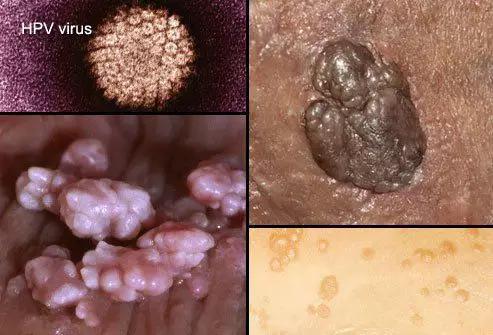  人乳頭瘤病毒的電鏡照片以及導(dǎo)致皮膚疾病癥狀（圖片來源：中國科學(xué)院微生物研究所）